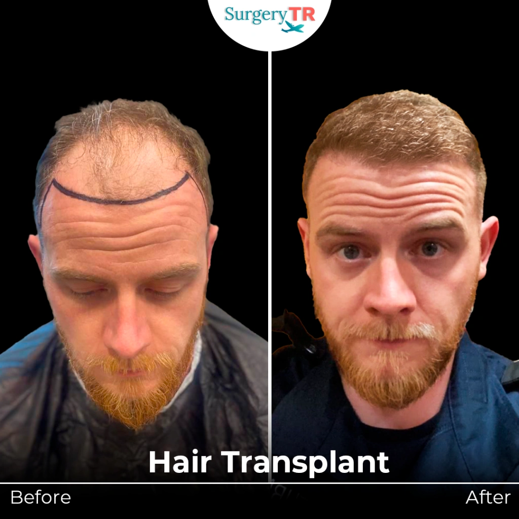 What is hair transplant