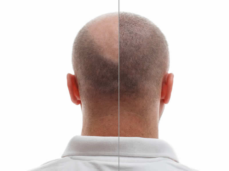 does hair fall out after transplantation operation