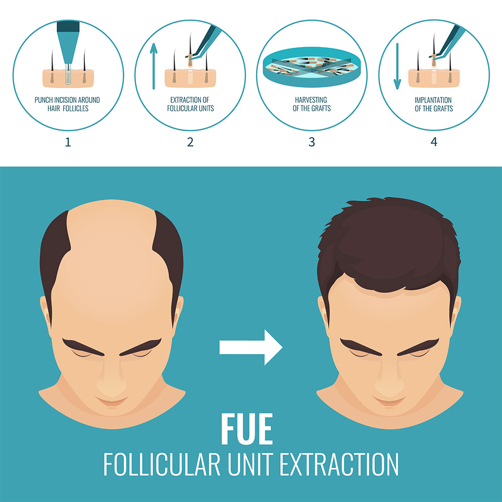 What Are the Main Hair Transplant Techniques?