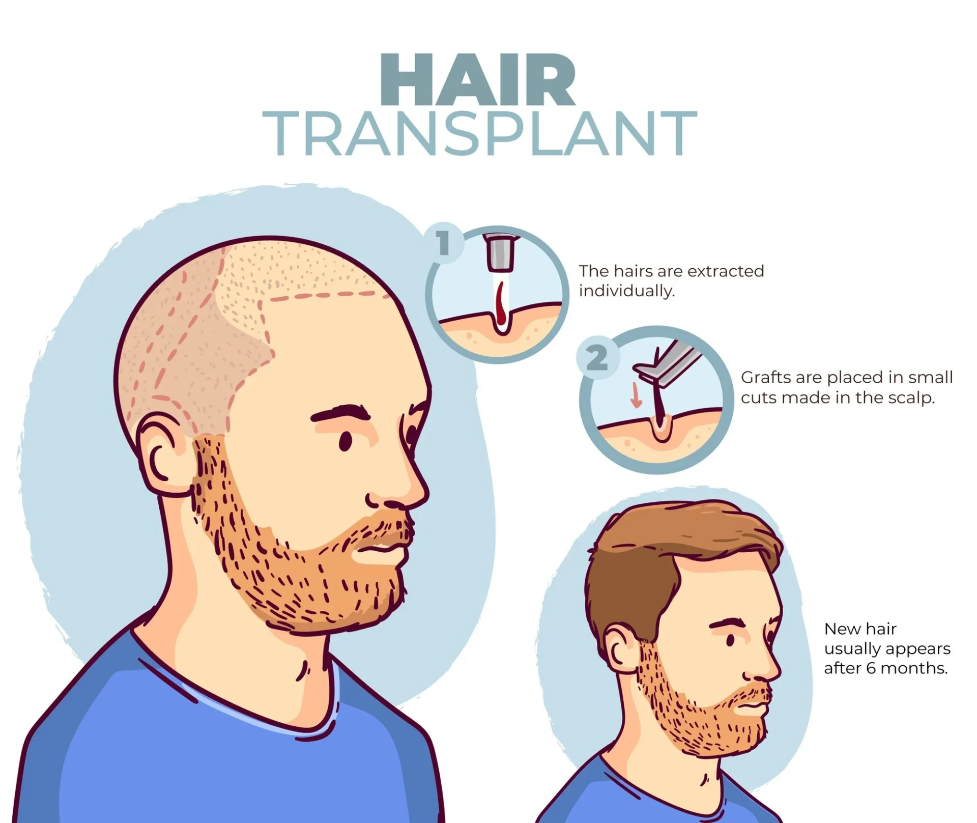 How Does a Hair Transplant Work?
