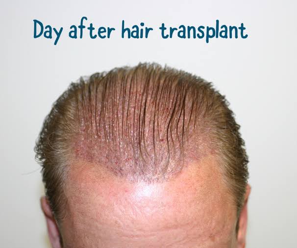 after the hair transplant