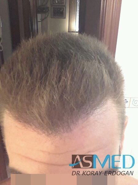 Before and After  graft    transplant at 
