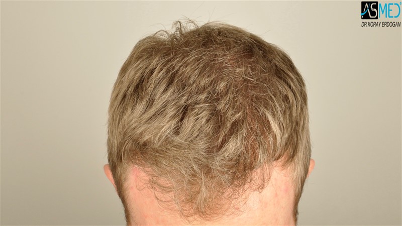Before and After  graft    transplant at 