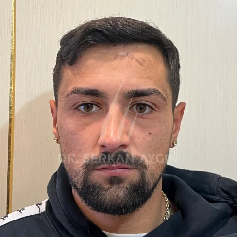DHI Hair Transplant Result