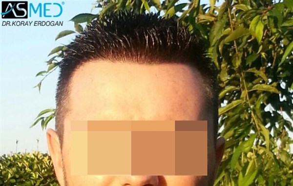 Before and After 3005 graft  FUE hair transplant at ASMED Medical Center