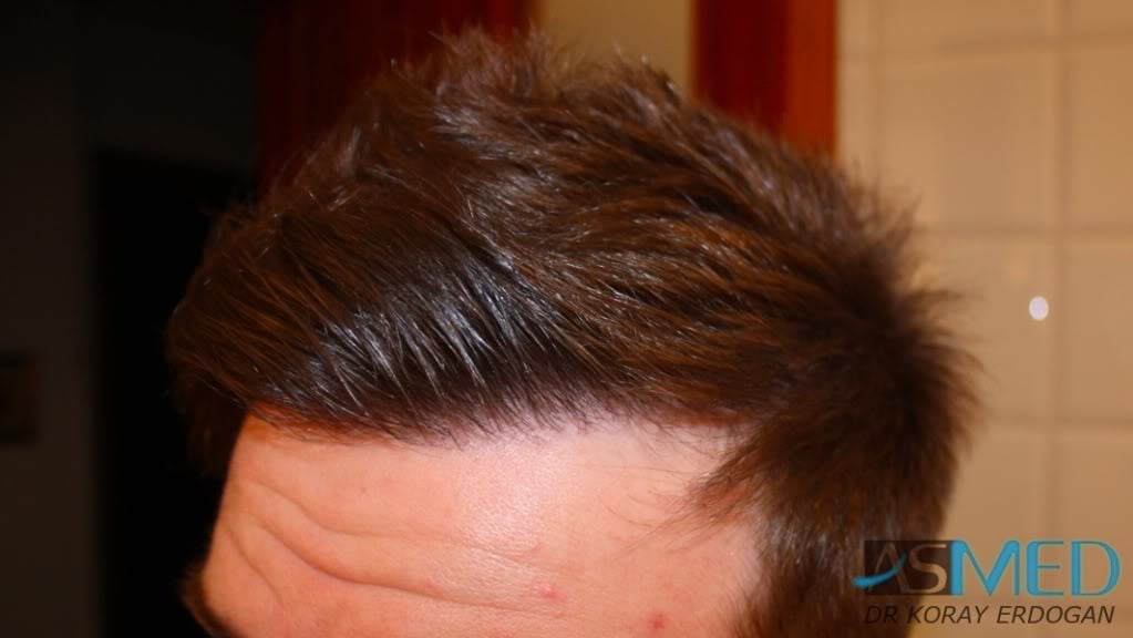 Before and After  graft    transplant at 