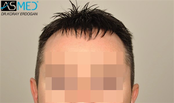 Before and After  graft    transplant at 
