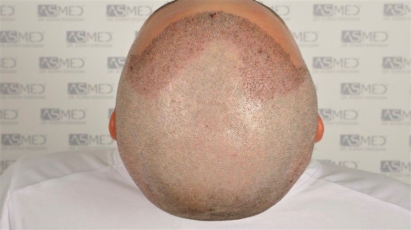 Before and After  graft    transplant at 