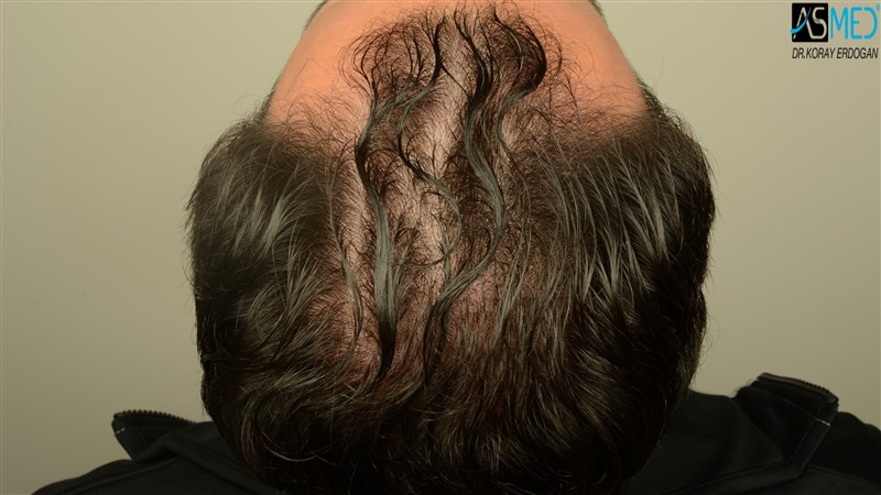 Before and After  graft    transplant at 