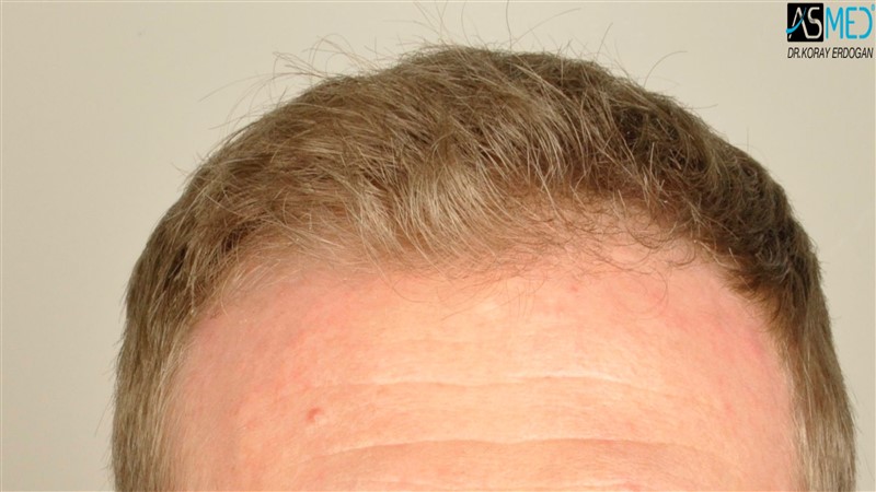 Before and After  graft    transplant at 