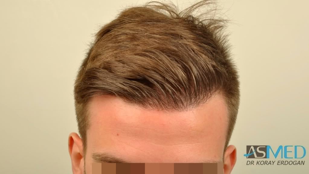 Before and After  graft    transplant at 