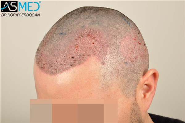 Before and After  graft    transplant at 