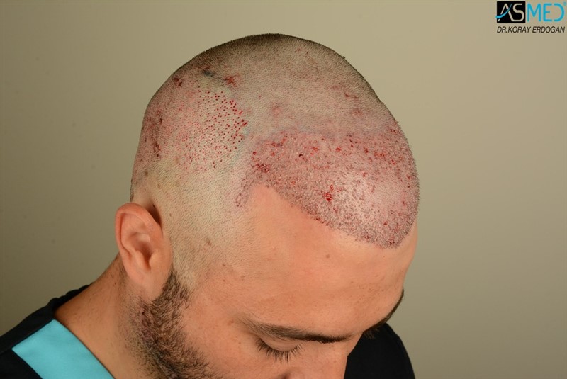 Before and After  graft    transplant at 