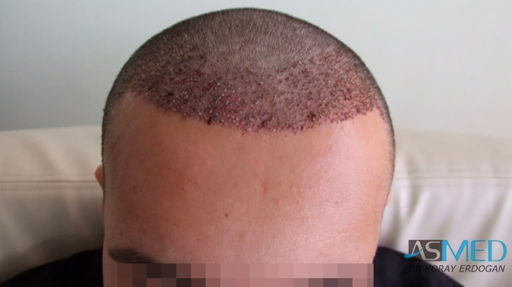 Before and After  graft    transplant at 