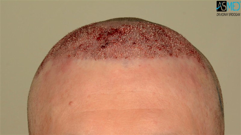 Before and After  graft    transplant at 
