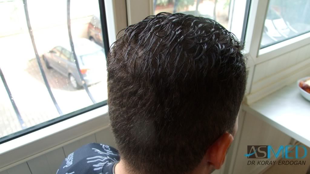 Before and After  graft    transplant at 