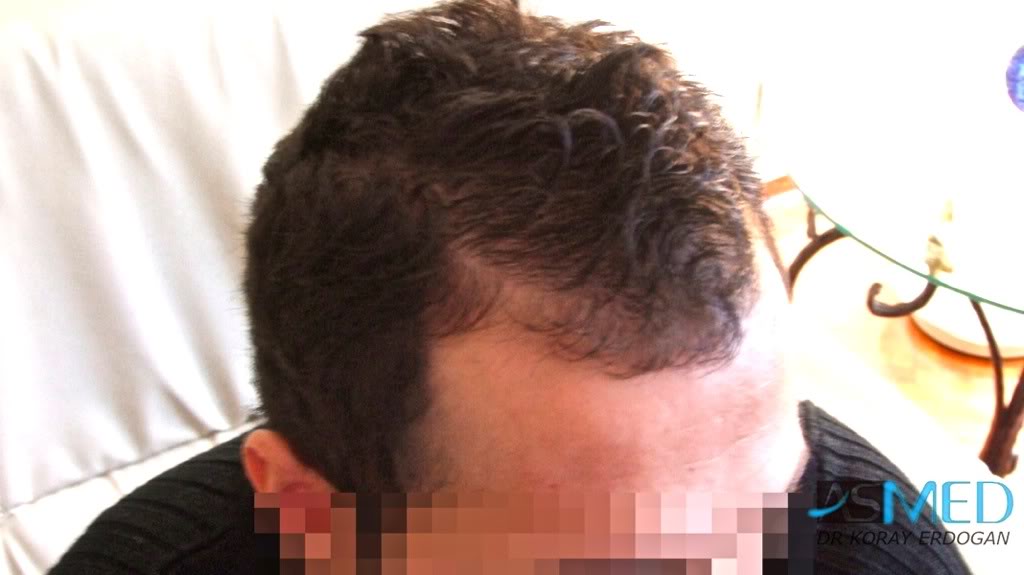 Before and After  graft    transplant at 