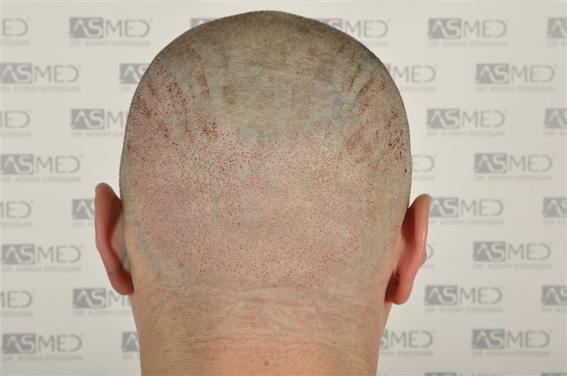 Before and After  graft    transplant at 