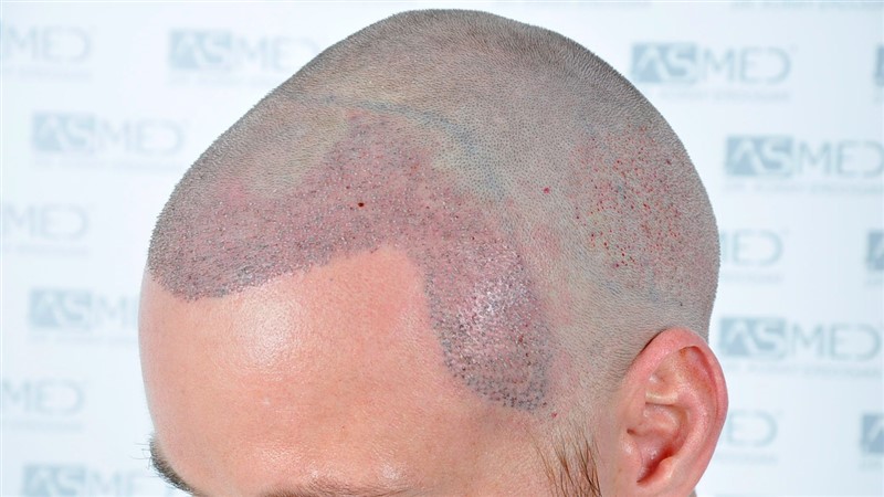 Before and After  graft    transplant at 