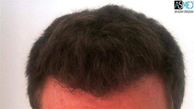 Before and After  graft    transplant at 