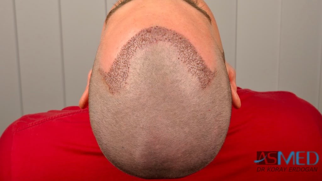 Before and After  graft    transplant at 