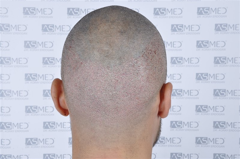 Before and After  graft    transplant at 