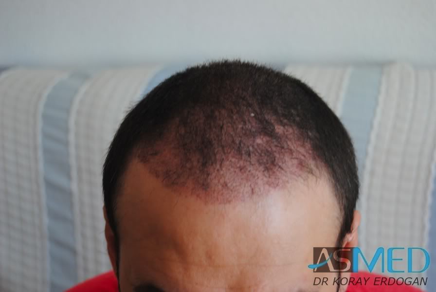 FUE Hair Transplant Result