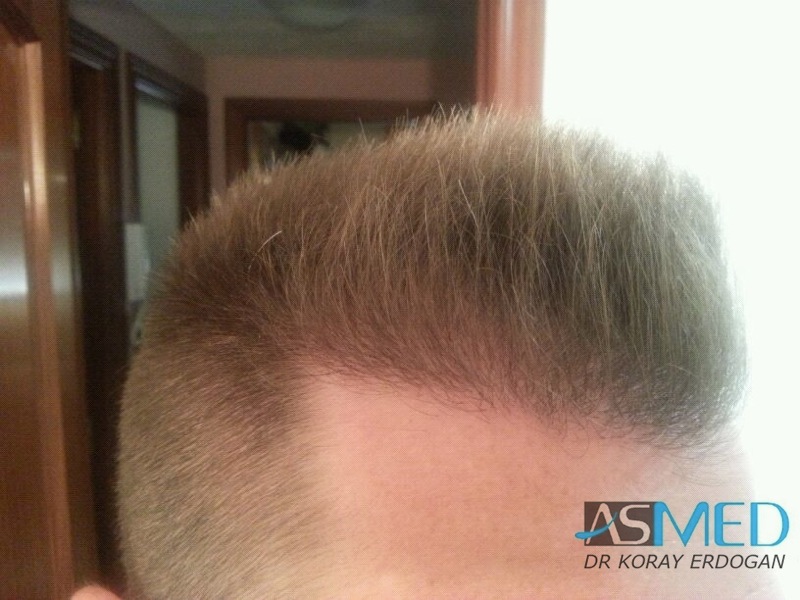 Before and After  graft    transplant at 