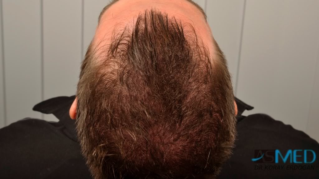 Before and After  graft    transplant at 