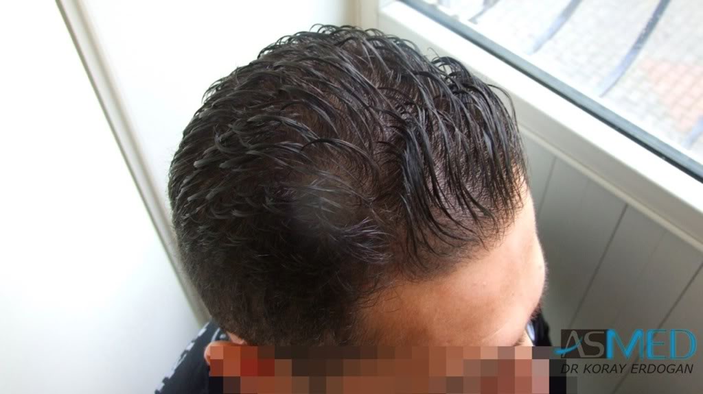 Before and After  graft    transplant at 