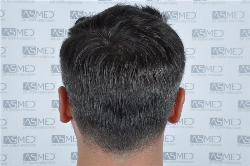 Before and After  graft    transplant at 