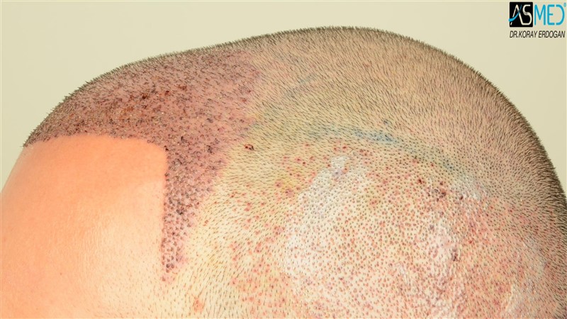 Before and After  graft    transplant at 