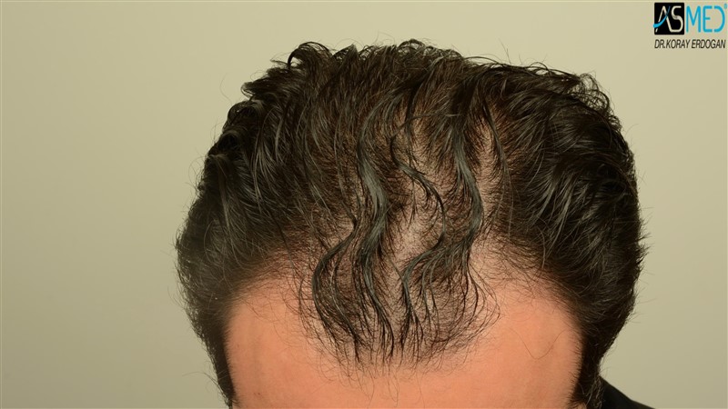 Before and After  graft    transplant at 