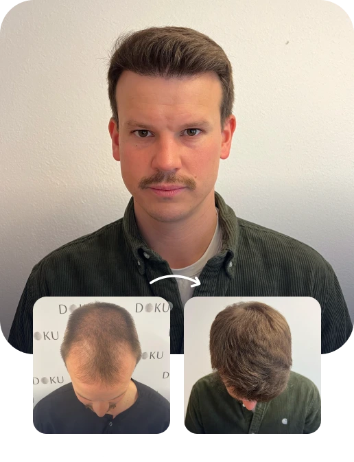 DHI Hair Transplant Result