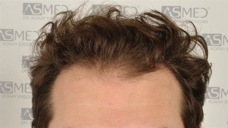 Before and After  graft    transplant at 