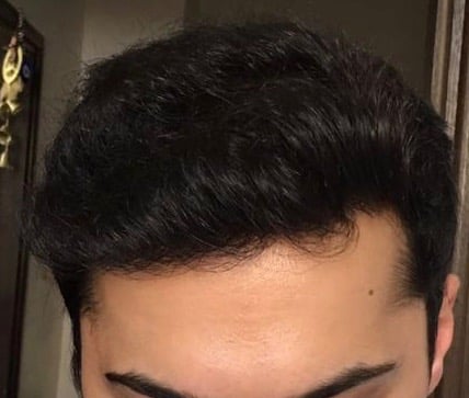 FUE Hair Transplant Result