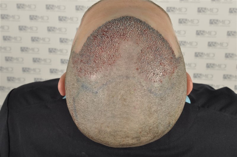 Before and After  graft    transplant at 