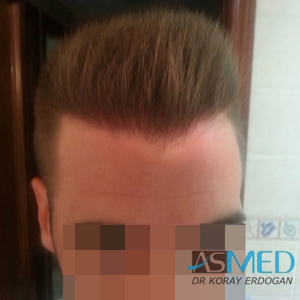 Before and After  graft    transplant at 