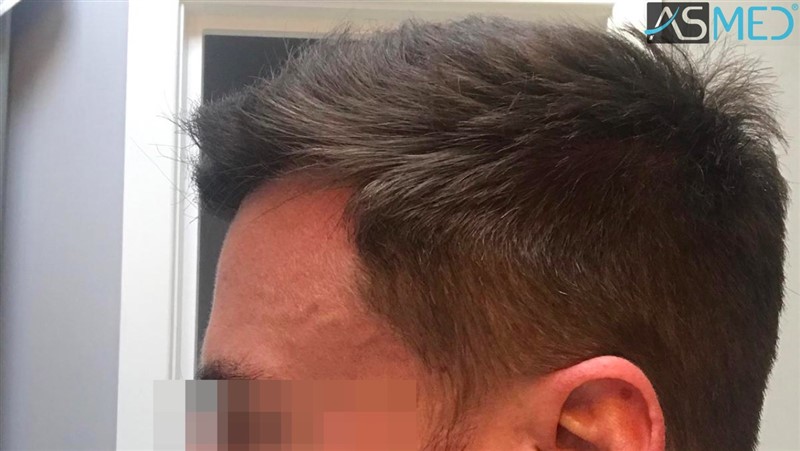 Before and After  graft    transplant at 