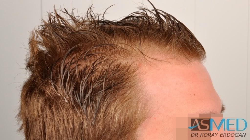 Before and After  graft    transplant at 