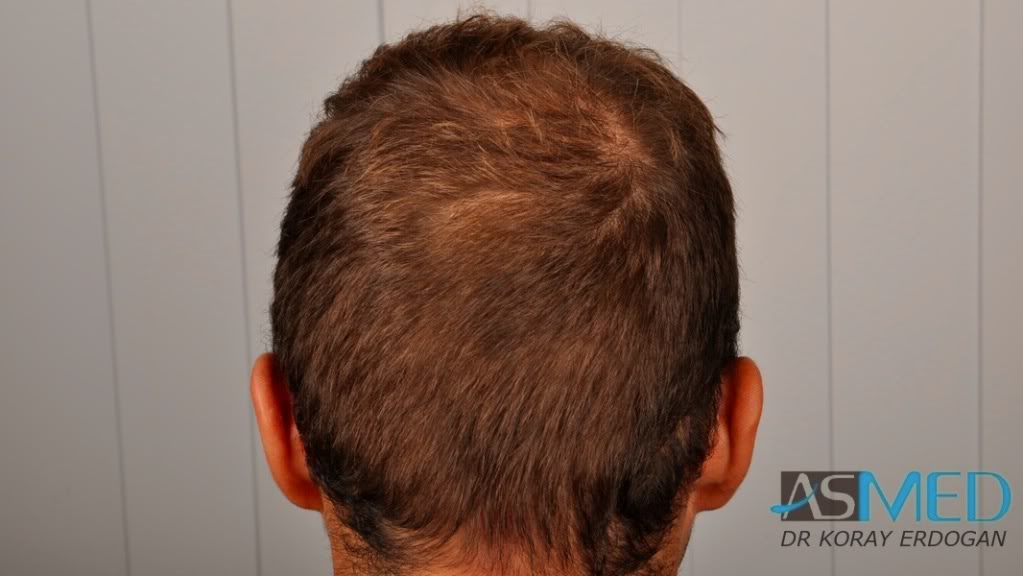 FUE Hair Transplant Result