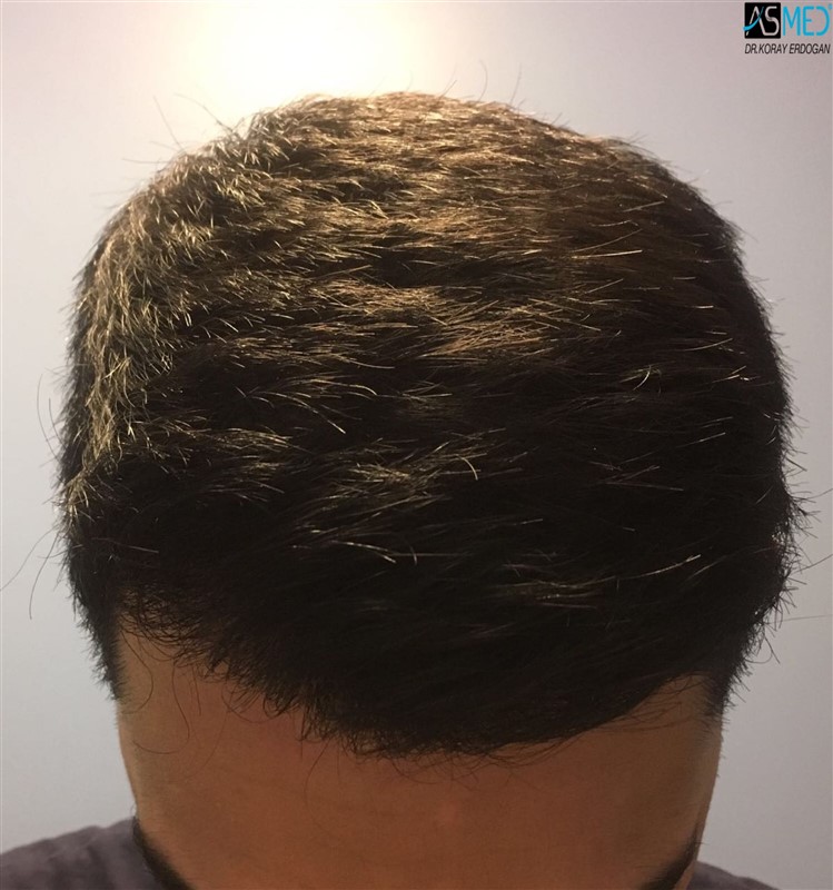 FUE Hair Transplant Result