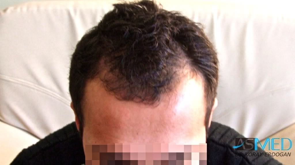 Before and After  graft    transplant at 