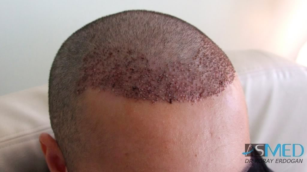 Before and After  graft    transplant at 