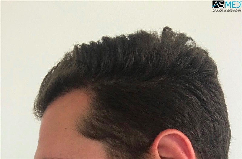 Before and After  graft    transplant at 