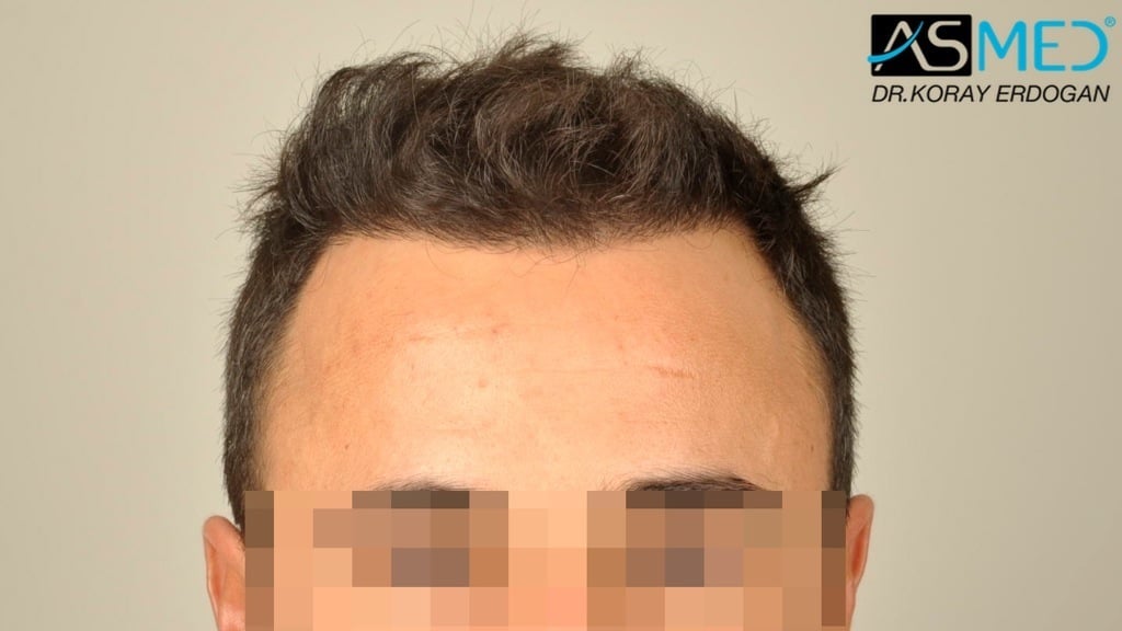 FUE Hair Transplant Result