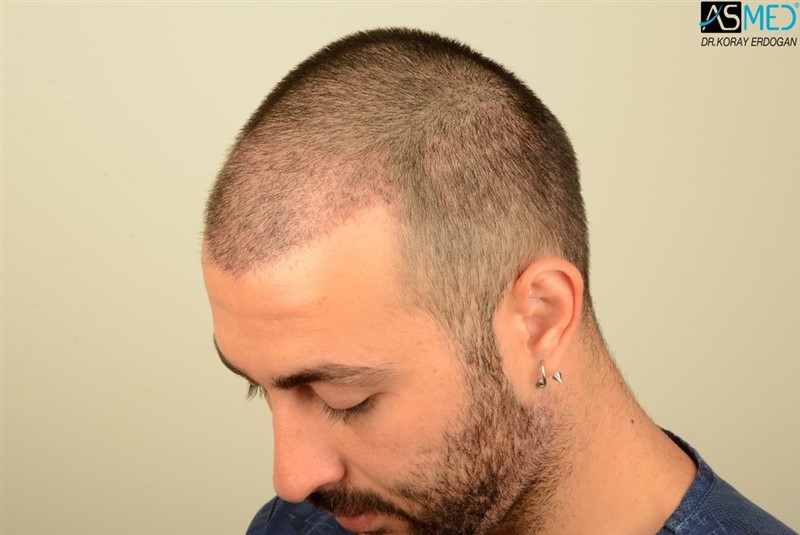 Before and After  graft    transplant at 