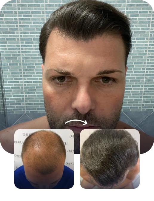 DHI Hair Transplant Result