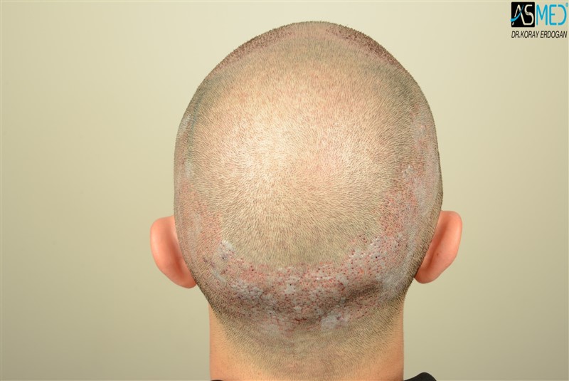 Before and After  graft    transplant at 