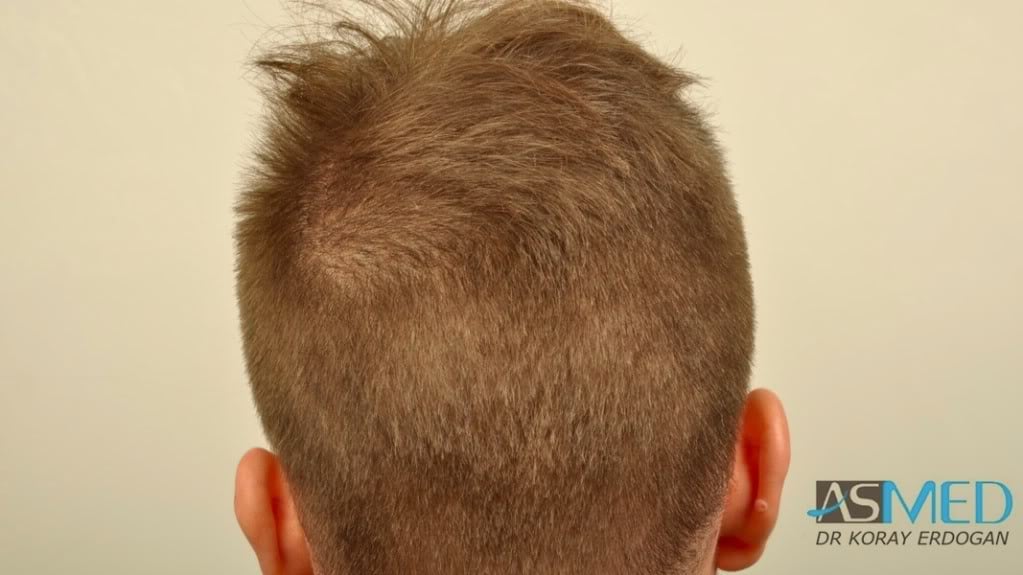 Before and After  graft    transplant at 